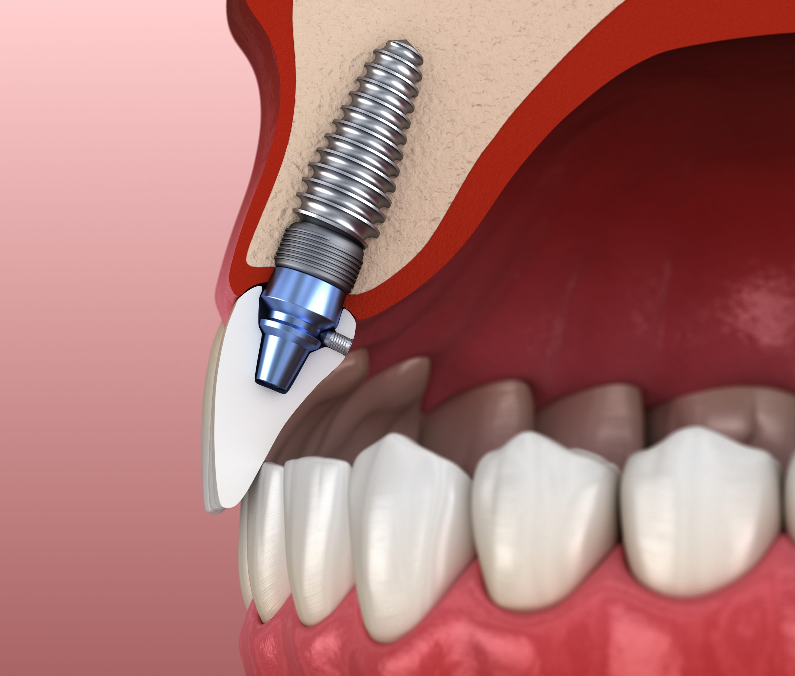 Dental Implant