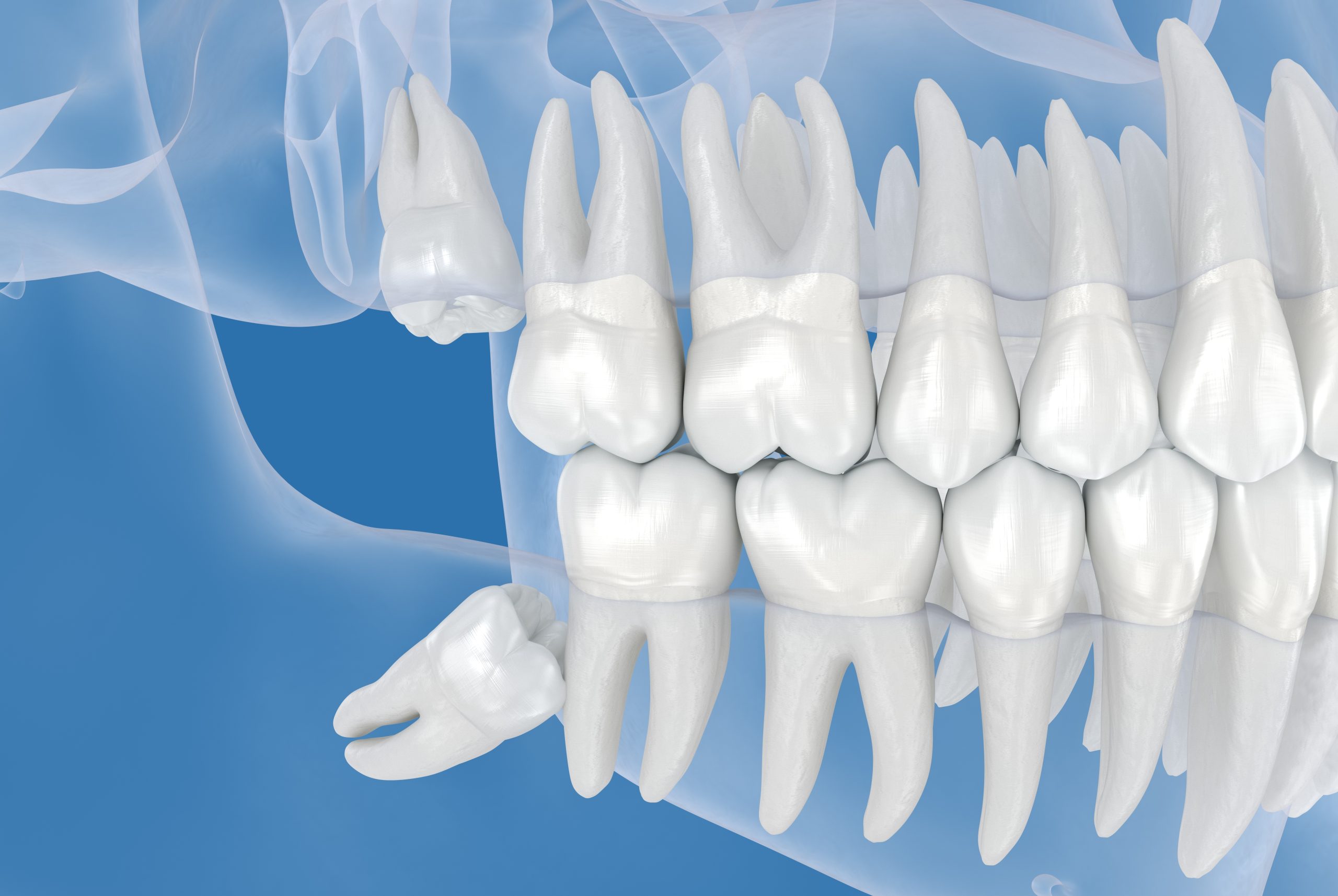 Illustration of impacted wisdom teeth