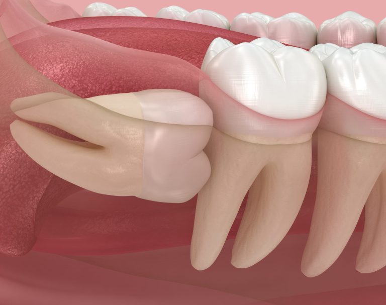 Illustration of impacted wisdom teeth